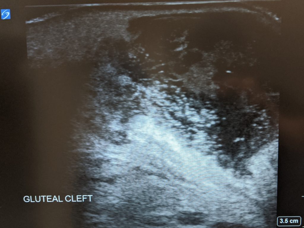 Ultrasound image of a pilonidal cyst.